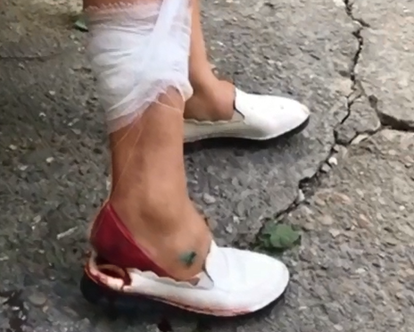 Нога была залита кровью: бродячие собаки порвали ногу женщине в Сочи