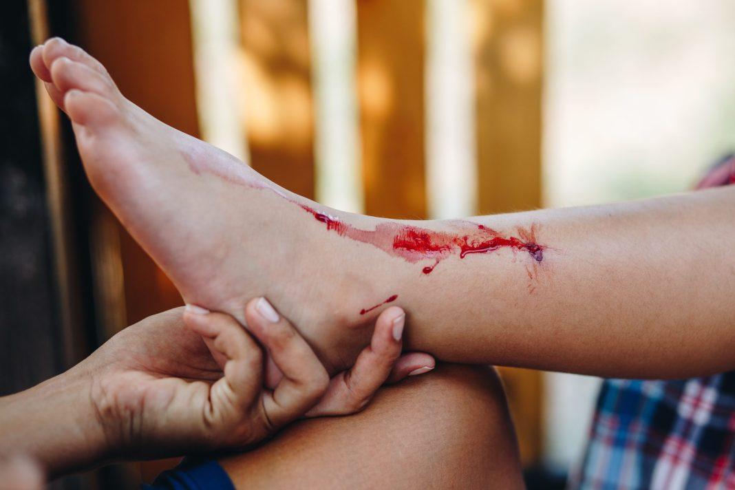 Известный инфекционист рассказал, что делать в случае пореза на пляже