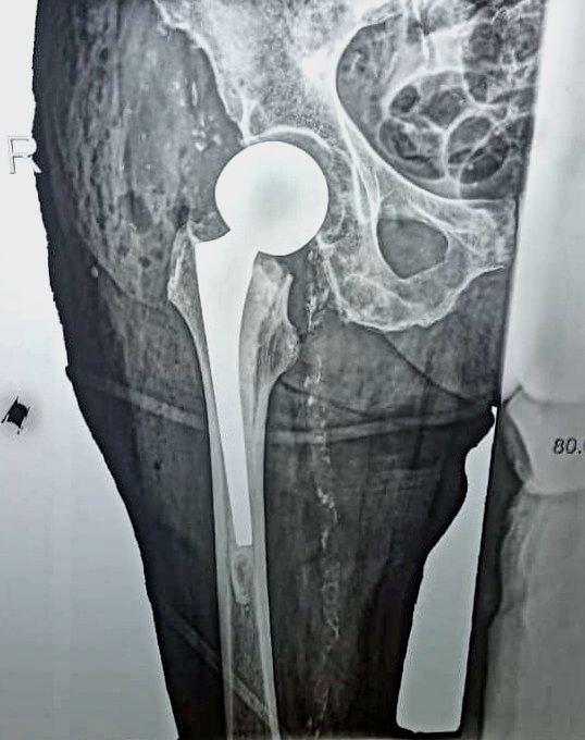 Сложную операцию на шейке бедра впервые провели в Усть-Лабинском районе