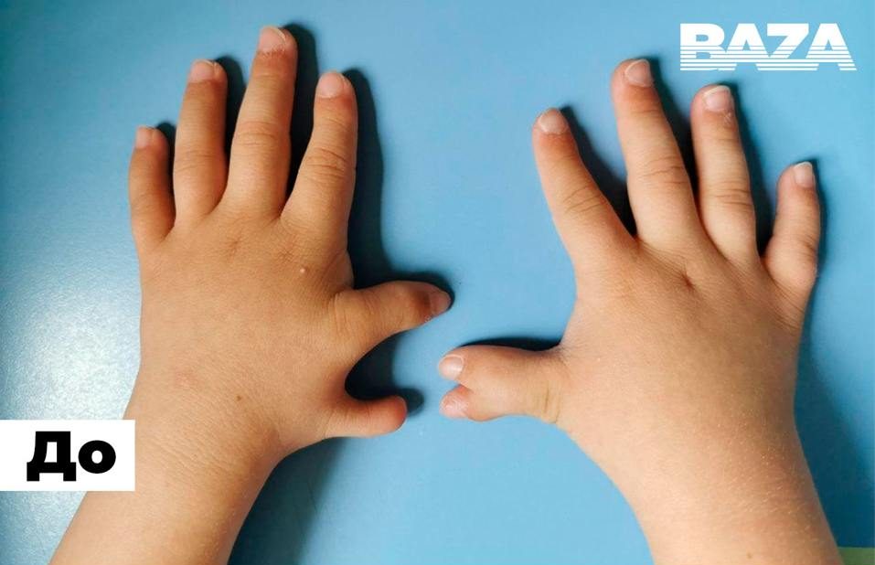 12-палый мальчик благодаря хирургам теперь может пользоваться рукой с пятью пальцами