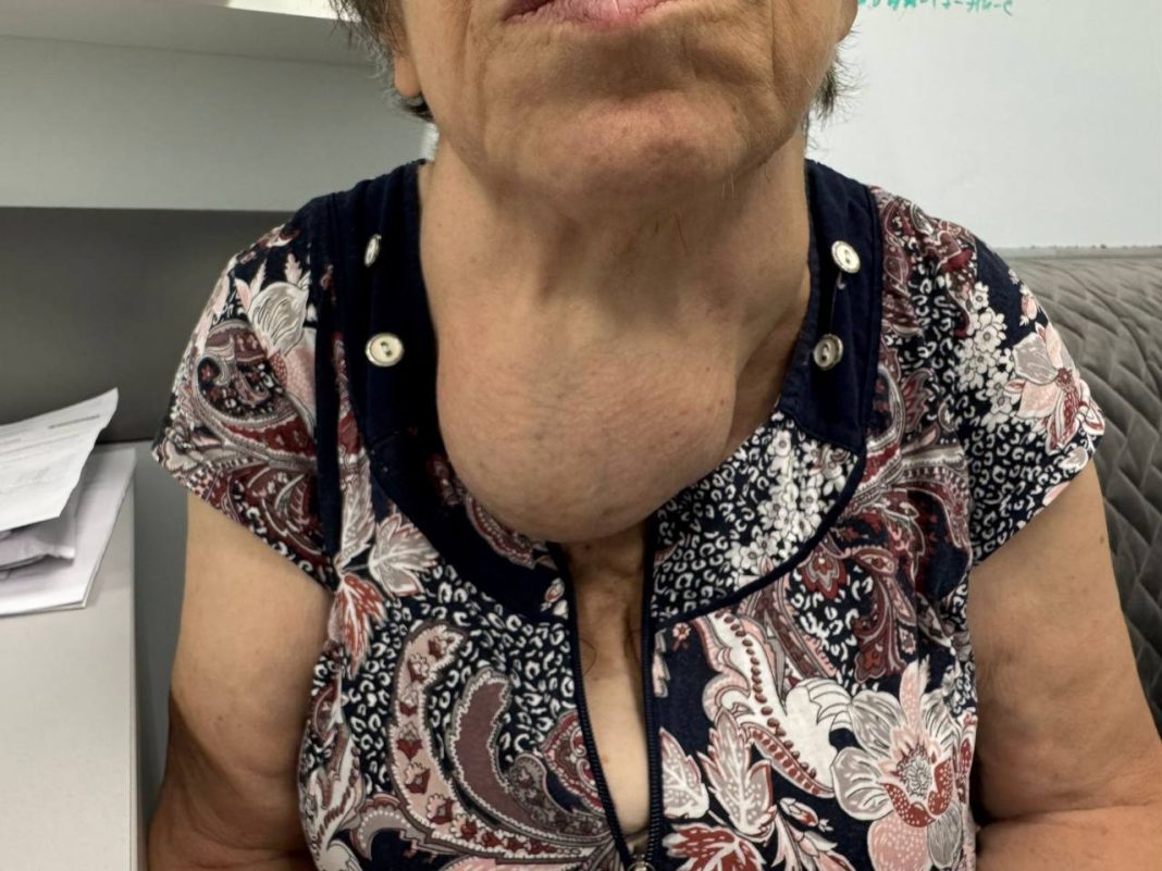 Сложнейшая операция в Сочи: хирурги удалили гигантскую опухоль весом в полкило