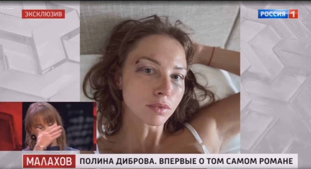 Полина Диброва показала синяки и шрамы у «Малахова» и в слезах призналась: «Это знает не каждый»